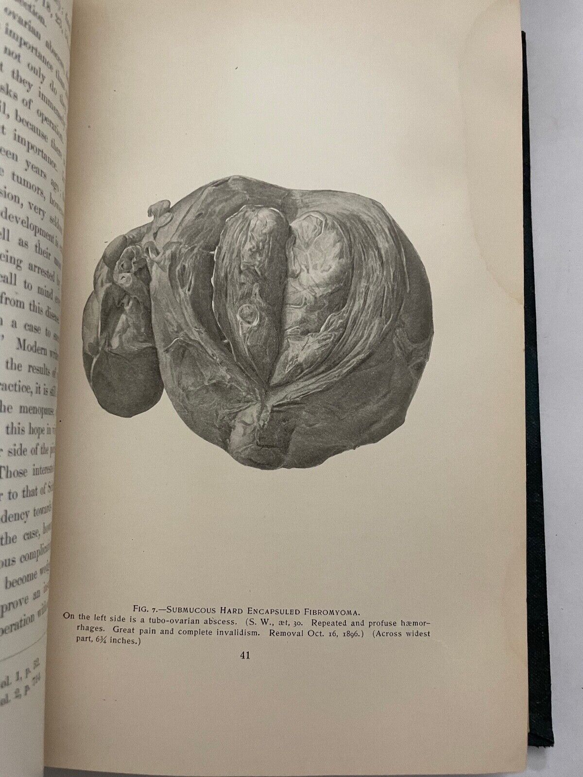 Uterine Fibromyomata; Their Pathology, Diagnosis and Treatment 1901