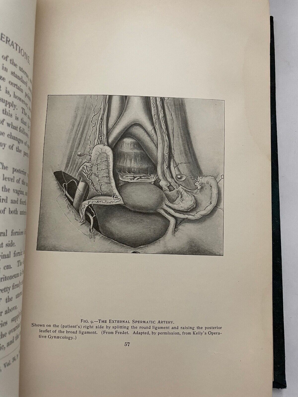 Uterine Fibromyomata; Their Pathology, Diagnosis and Treatment 1901