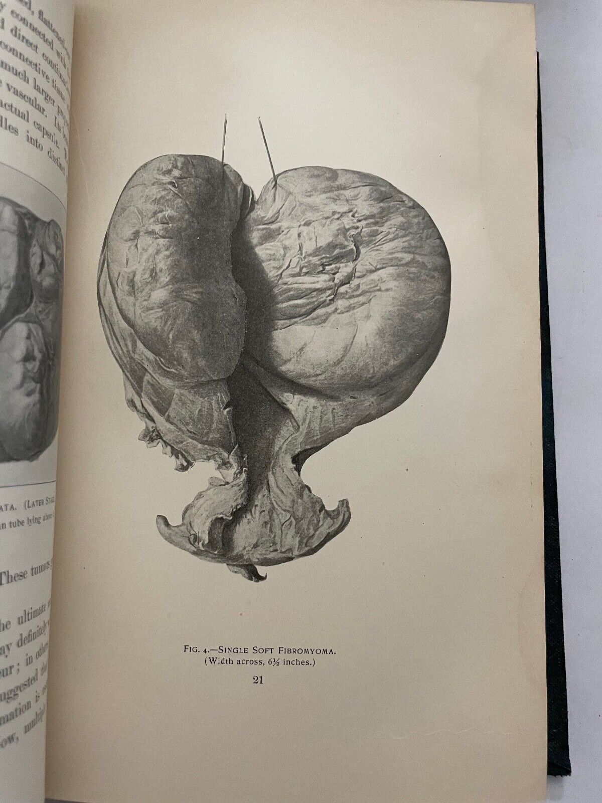 Uterine Fibromyomata; Their Pathology, Diagnosis and Treatment 1901