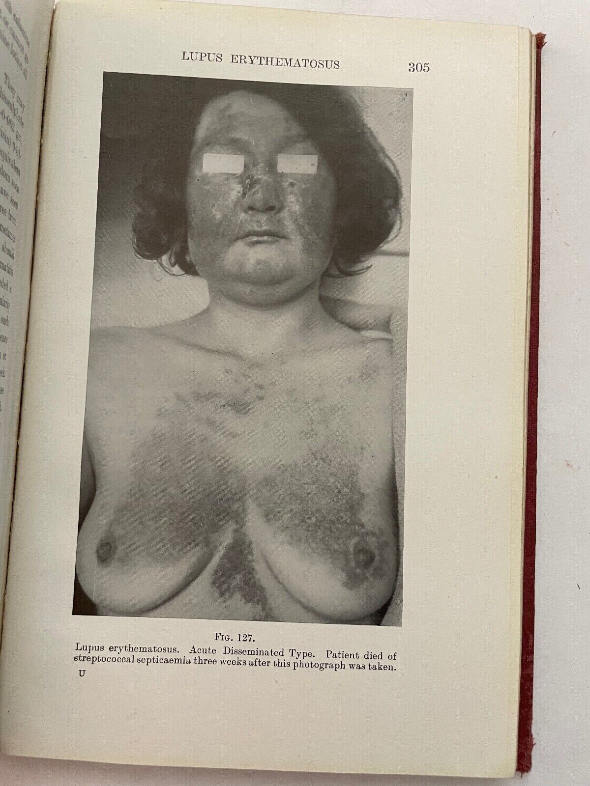 Common Skin Diseases by AC Roxburgh 7th edition