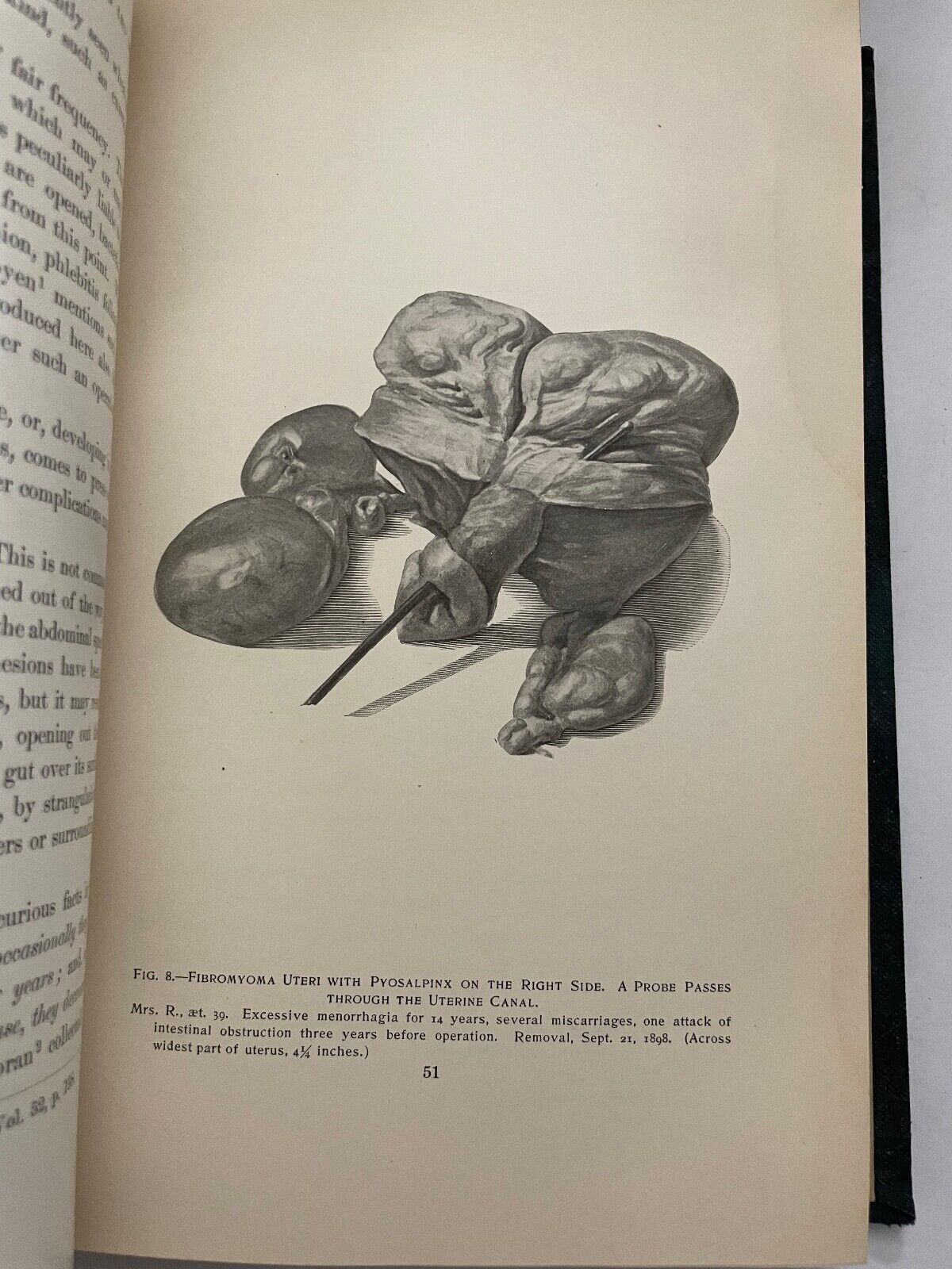 Uterine Fibromyomata; Their Pathology, Diagnosis and Treatment 1901
