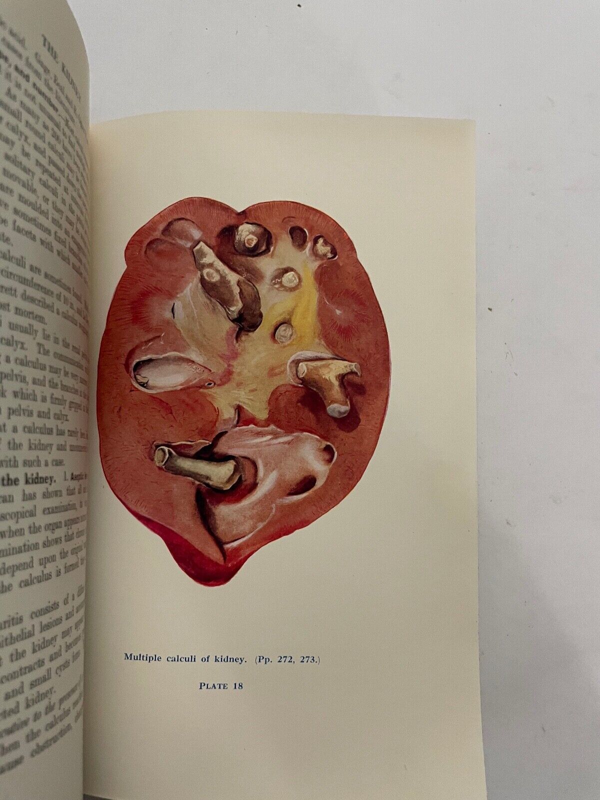 Surgical Diseases and Injuries of the Genito-Urinary Organs by J Thomson-Walker