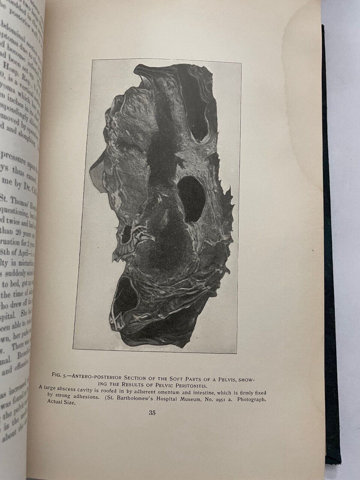 Uterine Fibromyomata; Their Pathology, Diagnosis and Treatment 1901