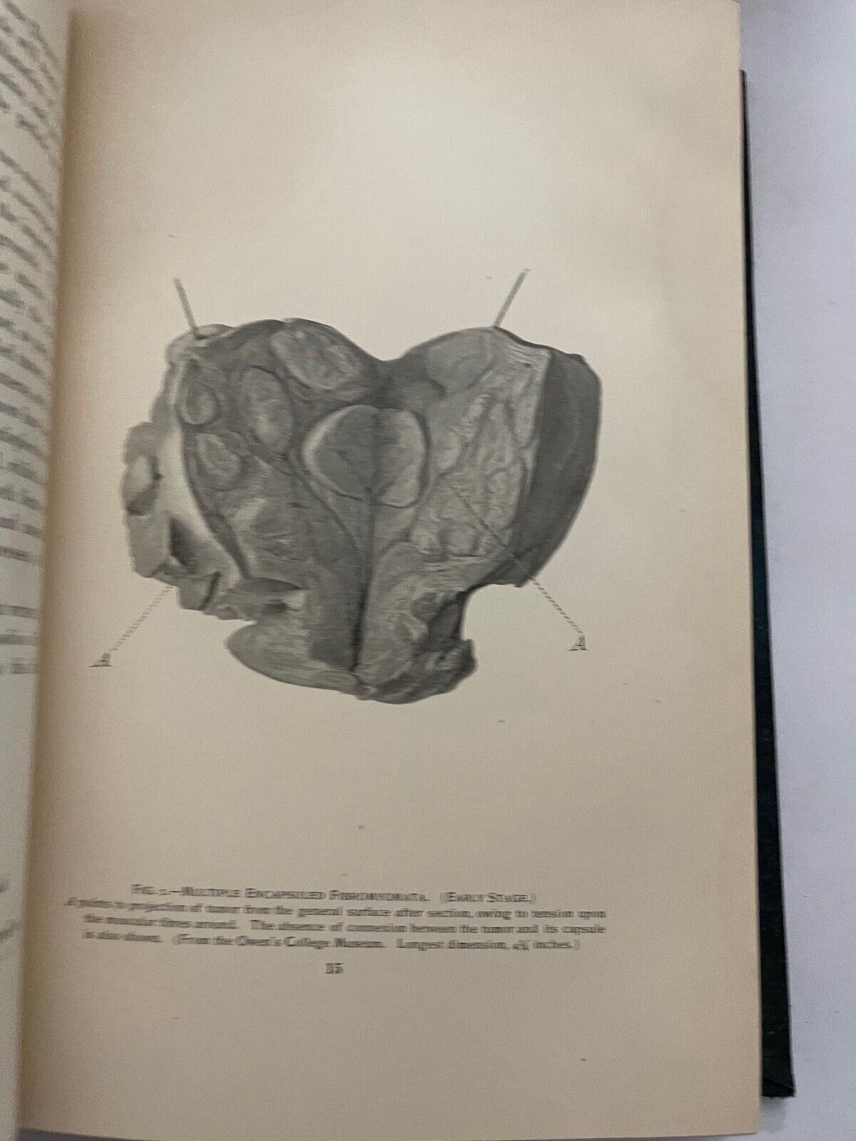 Uterine Fibromyomata; Their Pathology, Diagnosis and Treatment 1901