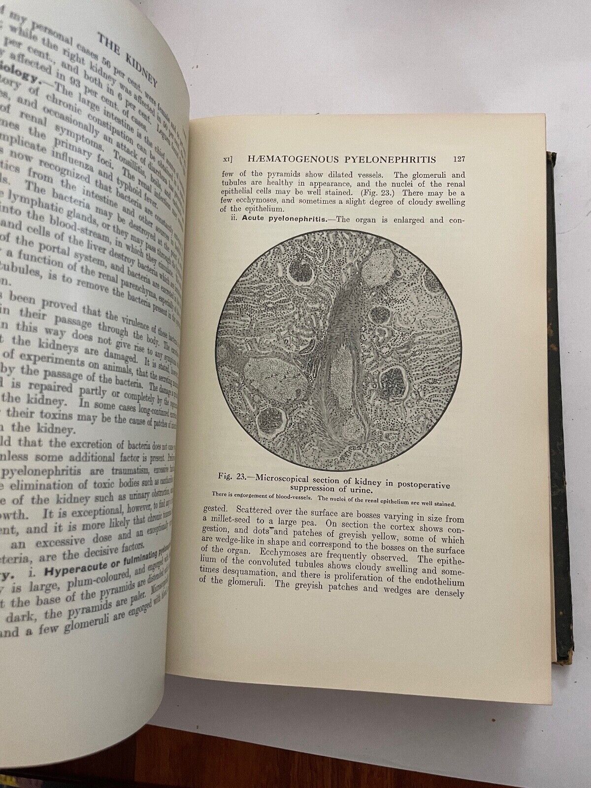 Surgical Diseases and Injuries of the Genito-Urinary Organs by John Thomson-Walk